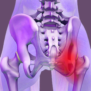 Acute Piriformis Pain