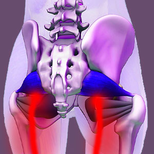 Bilateral piriformis pain