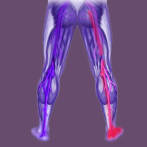 Piriformis Foot Pain