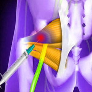 Piriformis injections