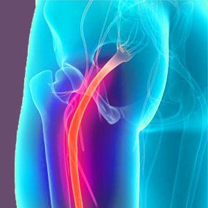 Piriformis Pain Prognosis