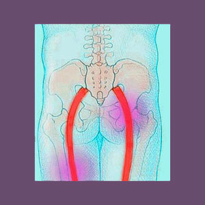 Piriformis Pain Sitting