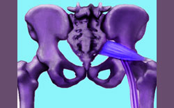 piriformis syndrome