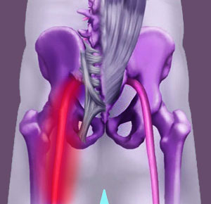 unilateral piriformis pain